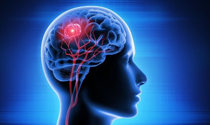 Tumor Cerebral no Adulto